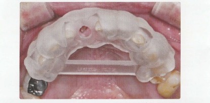 口腔内に装着したOneGuideサージカルガイド
